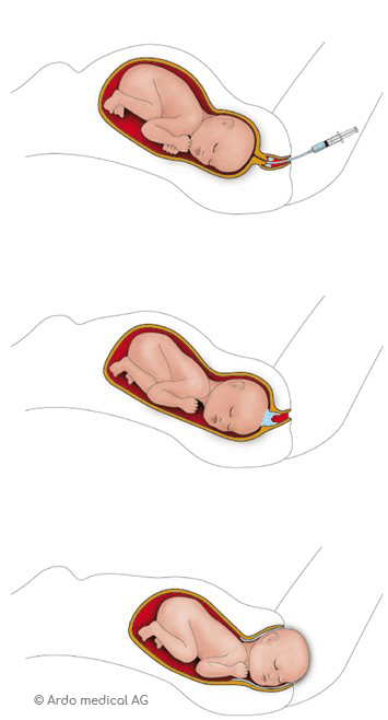 Ardo Natal Geburtsgel Anwendungszeichnung